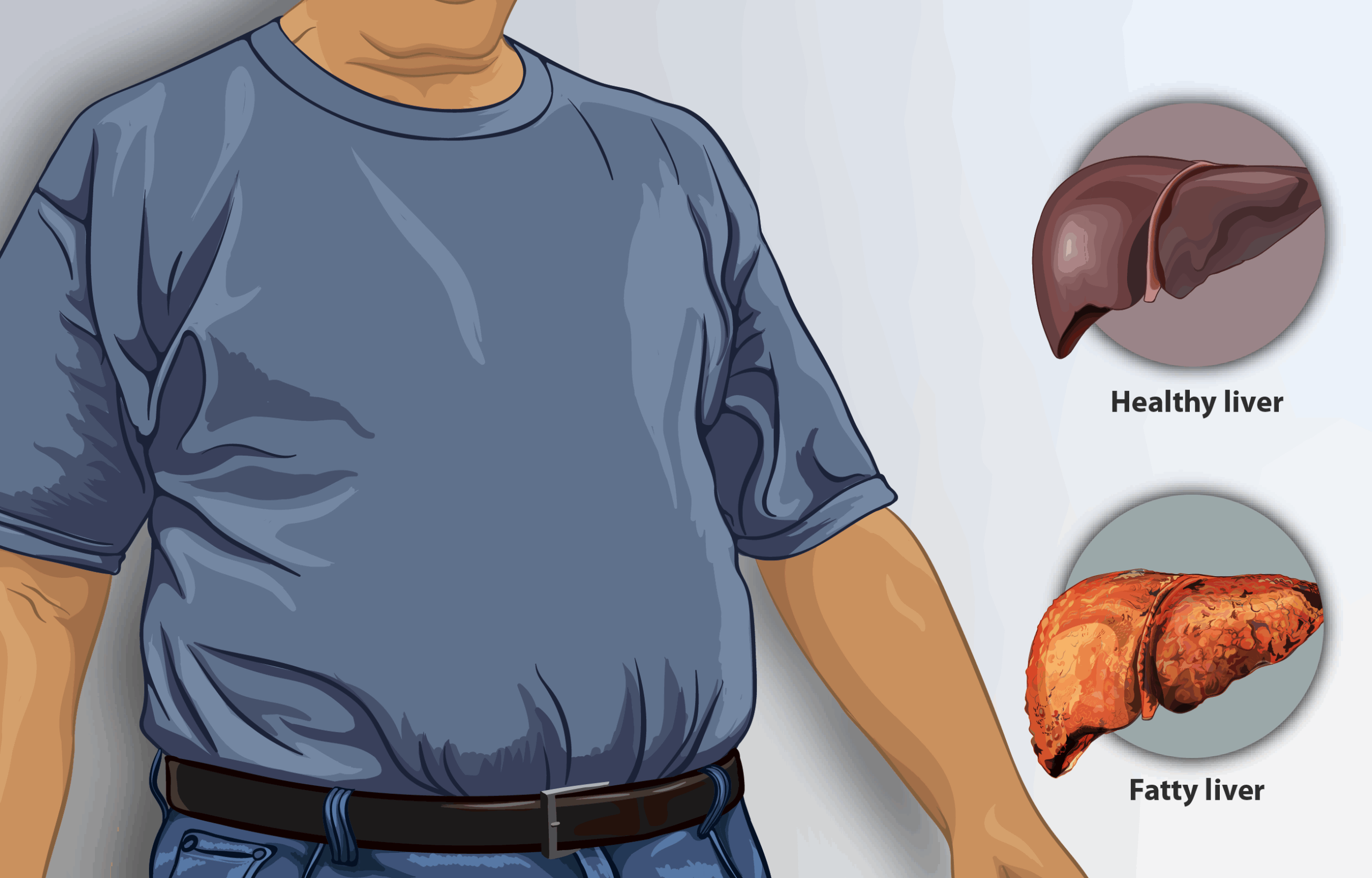 Illustrating metabolic risk factors for undiagnosed fatty liver disease"